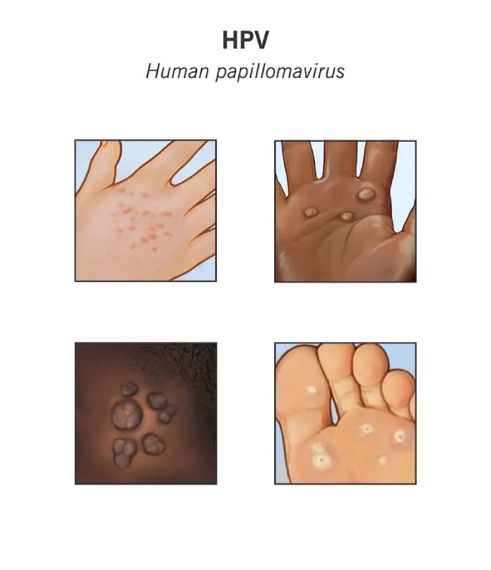 علائم hpv در زنان چیست؟